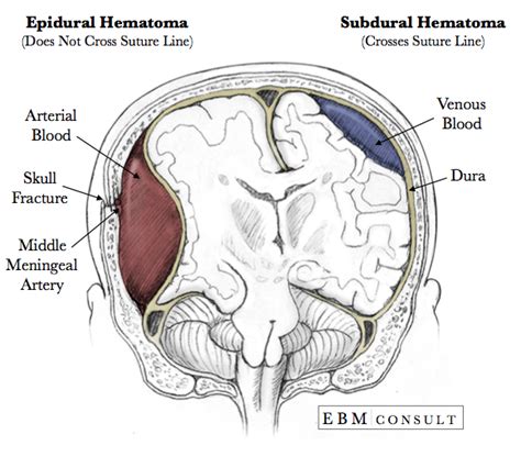 Subdural Hematoma Vs Epidural Hematoma - slidesharetrick