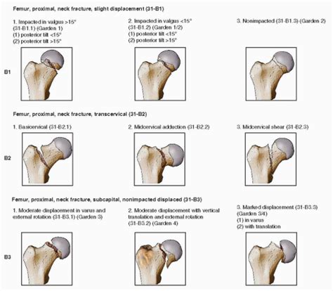 Hip Fracture Types