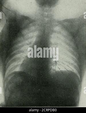 PULMONARY EDEMA, X-RAY Stock Photo - Alamy