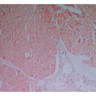 Colonoscopy showing a 10 mm sessile sigmoid colon polyp. | Download ...