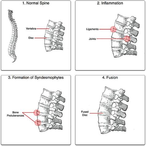 Ankylosing Spondylitis Treatment