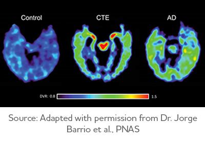 Cte Brain Compared To Normal Brain : Mri Of Truamatic Brain Injury By Dr David J Mikulis Youtube ...