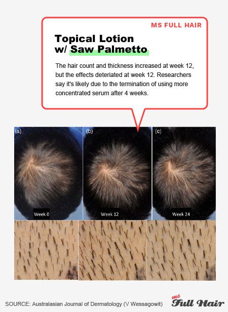 The Ultimate Saw Palmetto-Hair Loss Guide (+ 2 SP Growth Recipes)