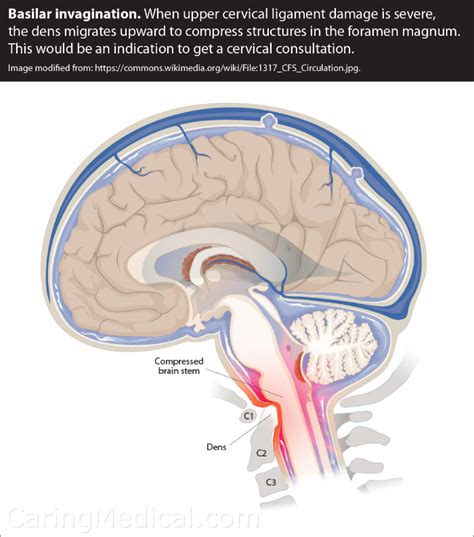 Basilar Invagination And Cervical Spine Instability Caring Medical | My XXX Hot Girl