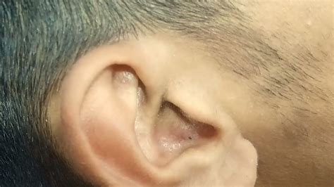 Newest Massive Big Blackheads in Ear Full Extraction Official Video 2021 - YouTube