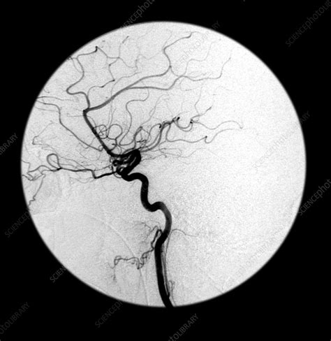 Internal Carotid Artery, Angiogram - Stock Image - C007/5818 - Science Photo Library