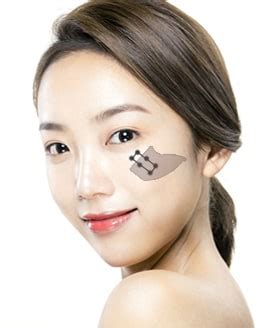 Cheekbone Reduction | VIP Plastic Surgery Korea