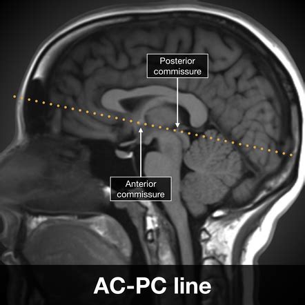 Anterior commissure - posterior commissure line | Radiology Reference ...