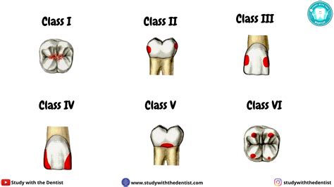 Classification Of Dental Caries Classification Of Dental Caries | The Best Porn Website