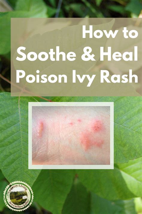 Best Way To Cure Poison Ivy Rash