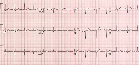 Inter-Canyon Fire Rescue: ICFR paramedics obtain 12 lead ECG in the field to shorten time to ...