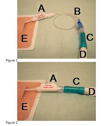 Nursing Care And Management Of Patients With A Nephrostomy