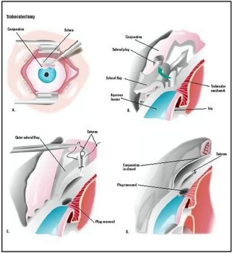 Trabeculectomy, One Surgery For Glaucoma | HubPages