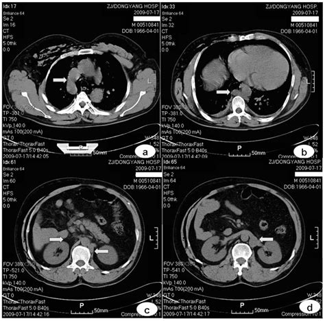 Plain scanning: (a) the clearly-thickened azygos vein (arrow) arches ...