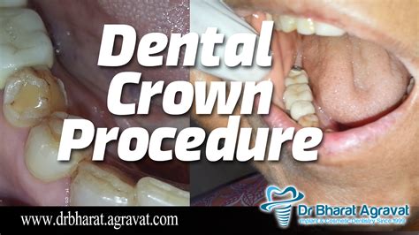 Dental Crown procedure cost for broken, Caries, after root canal ...