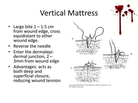 PPT - Suturing Basics PowerPoint Presentation - ID:2156670