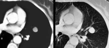 Lung Hamartoma Imaging: Overview, Radiography, Computed Tomography