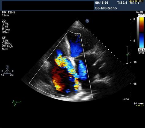 Pin on Ekg