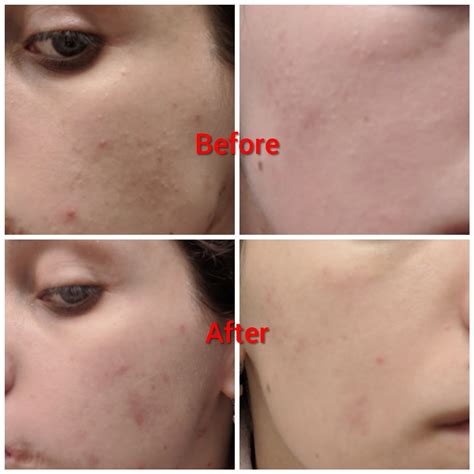 3 week results after switching salicylic acid gel for differin (0.1%) and CeraVe PM lotion (pump ...