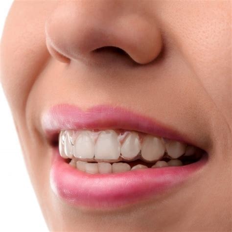 Invisalign Treatments for Straighter Teeth