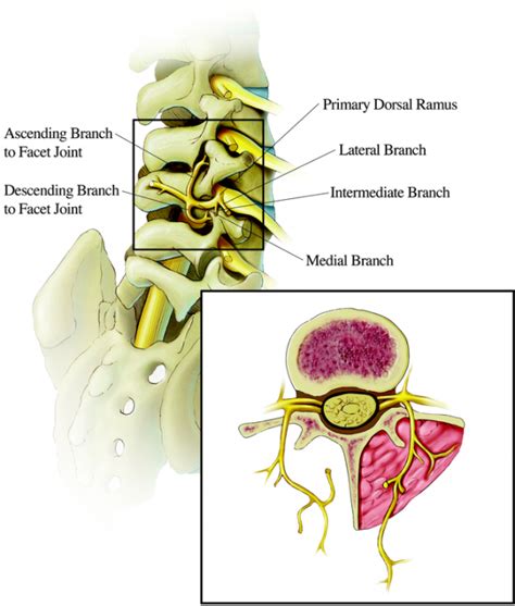 Lumbar Facet Syndrome | Market tay