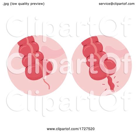 Appendicitis Appendix Inflammation Illustration by BNP Design Studio #1727520