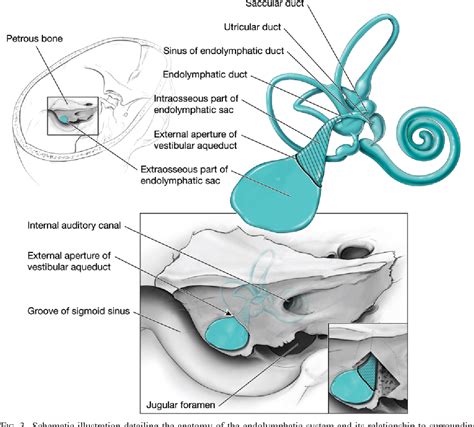 Figure 3 from The vestibular aqueduct: site of origin of endolymphatic sac tumors. | Semantic ...