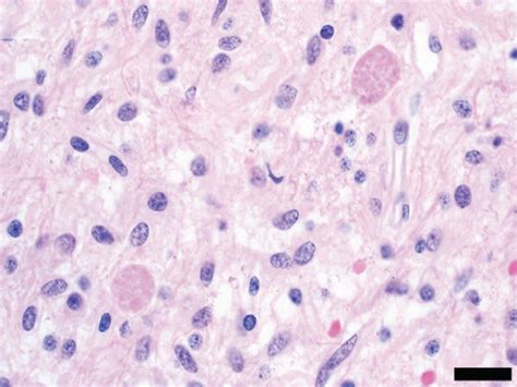 Pilocytic astrocytoma radiographic and histopathologic features. Brain... | Download Scientific ...