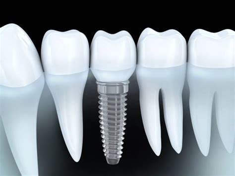 Dental implants dentist Houston | Dental implants specialist Houston