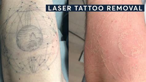 Laser Tattoo Removal Before and After - Central London - YouTube