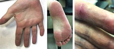 Palmar-plantar erythrodysesthesia on the background of taking sorafenib | Download Scientific ...