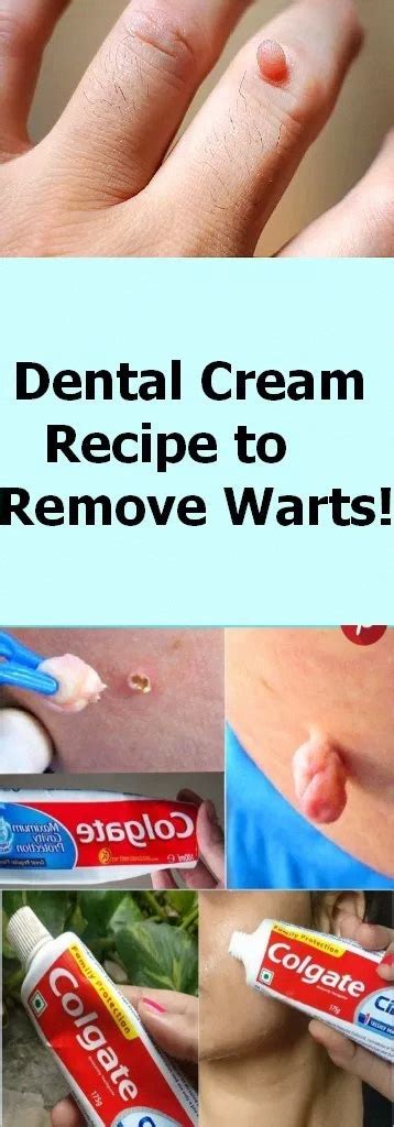 Pin on What Is The Best Way To Remove Warts