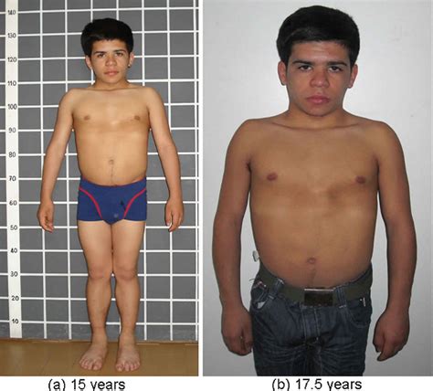 Growth hormone deficiency causes, symptoms, diagnosis, treatment & prognosis