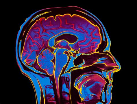 What Is Norepinephrine?