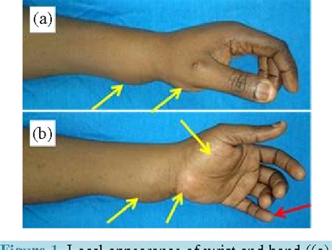 Figure 4 from Giant Bursitis of Wrist and Multiple Tenosynovitis of Hand with Rice Body ...