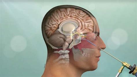 Types of Brain Surgery - Spine & Brain Clinic