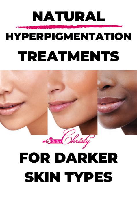 Hyperpigmentation Treatments for Black Skin | Hyperpigmentation ...