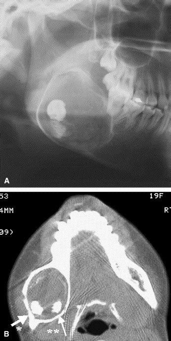 Calcifying odontogenic cyst: Radiologic findings in 11 cases - Oral Surgery, Oral Medicine, Oral ...