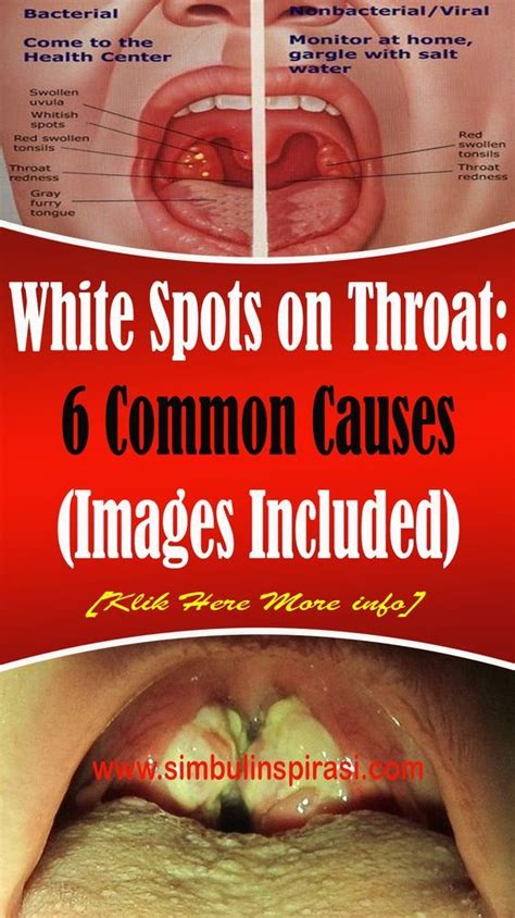 White Spots on Throat: 6 Common Causes (Images Included) - abilenebeuty.blogspot.com
