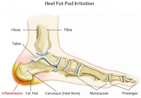 Heel Fat Pad Syndrome Causes, Symptoms, Diagnosis Treatment, 50% OFF