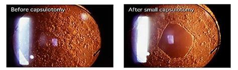 Yag Capsulotomy - Sydney Retina Clinic