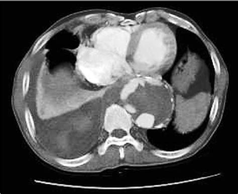 Figure 1 from Non-Anastomotic Rupture of a Woven Dacron Graft in the ...