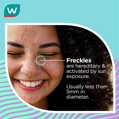 Freckles: Causes, types & when to see a doctor | Watsons Singapore