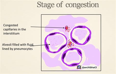 Pathology of Lobar Pneumonia - Pathology Made Simple