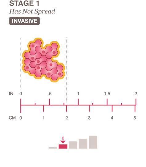 Stage 1 Breast Cancer Explained - Symptoms & Treatment