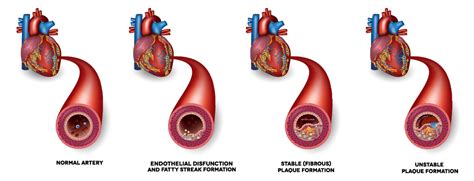 Atherosclerotic plaque in arteries overview • Heart Research Institute