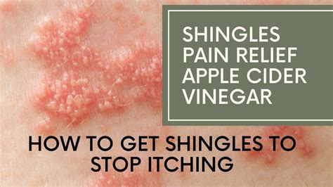 Shingles pain relief apple cider vinegar | How to Get Shingles to Stop Itching - YouTube