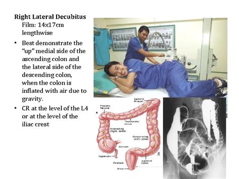 Radiographic Positioning for Barium Enema Presented by Aries