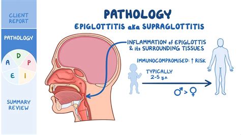 mytest: 17: Tripod Position Child Epiglottitis