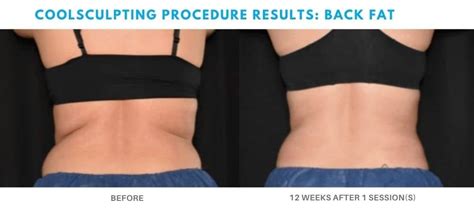 CoolSculpting Elite Results